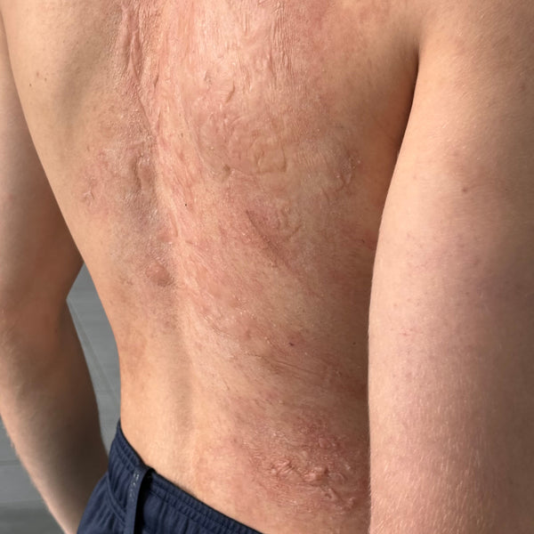 Tutorial de Quemaduras de 3er Grado: Creando Ampollas y Textura con solo 2 Productos de tu Kit